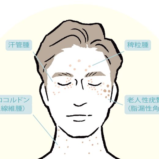 イボの種類