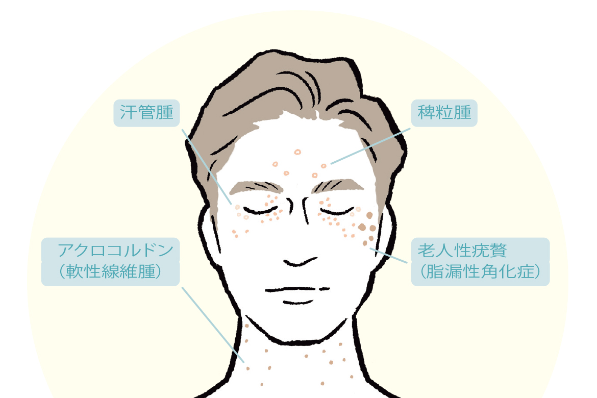 イボの種類
