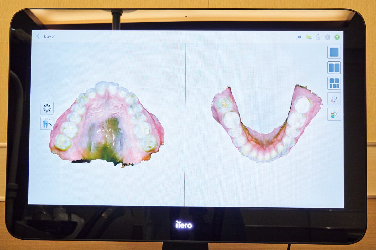 「麻布まさる矯正歯科」の口腔内3Dスキャナーの画面